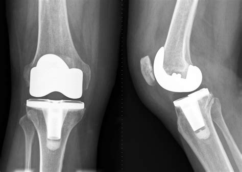 The Facts About Total Knee Replacement Surgery