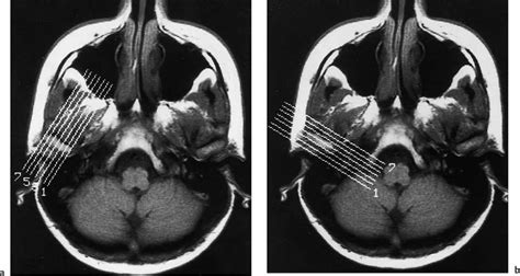 Tmj Axial Mri