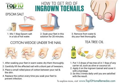 Home Remedies for Ingrown Toenails | Top 10 Home Remedies