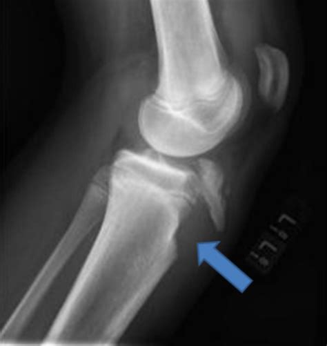 Patella Tendon Rupture – Core EM