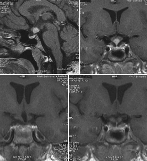 Cerebellopontine Angle Tumors | Neupsy Key