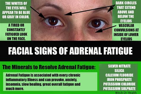 Fatigue Adrenal Gland Symptoms