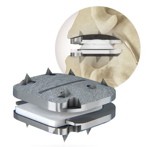 Centinel Spine® Announces First Commercial Use of the prodisc® C Vivo ...