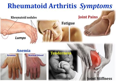 Arthritis Symptoms