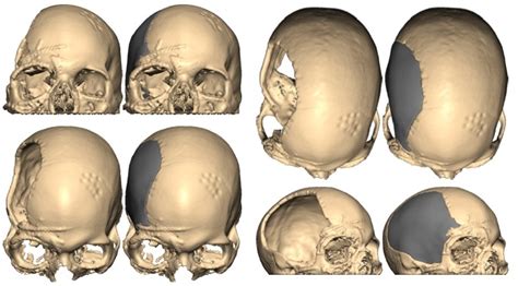 Craniofacial Surgery Boston | Boston Plastic Surgery