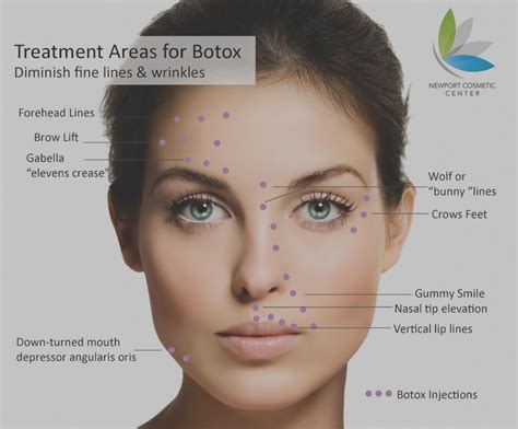 Facial Diagram Botox Injection Sites ... | Botox injection sites, Botox ...