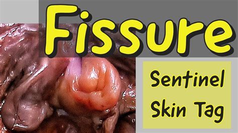 FISSURE & Sentinel skin Tag - TREATMENT - YouTube