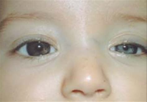 Left pupillary miosis, marked hypochromia of the left iris, ipsilateral... | Download Scientific ...