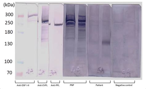 | Results of immunoblot analysis on patient serum collected on week 7 ...