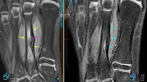 PERIOSTEAL REACTION RADIOLOGY MRI: THE RANGE OF TRAUMATIC PERIOSTEAL ...