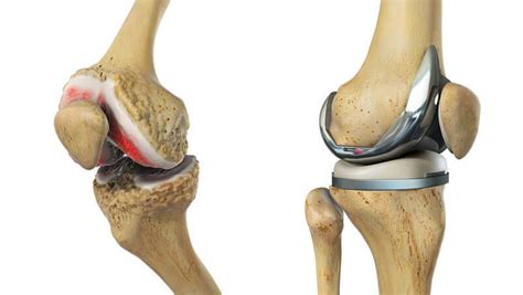 Cost involved in knee replacement | Life Cares