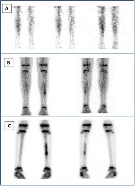 a. Three-phase bone scan from the legs: Upper row (A): anterior images ...