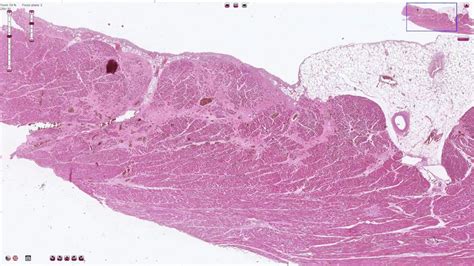 Disperse Myocardial Fibrosis - Histopathology - YouTube