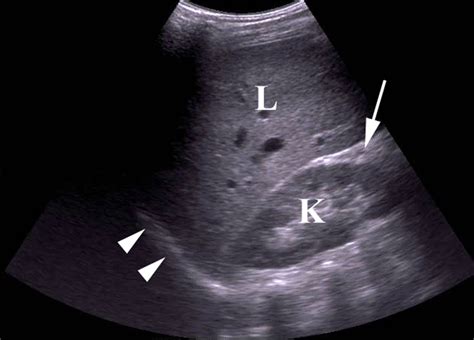 Kidney Ultrasound: March 2015