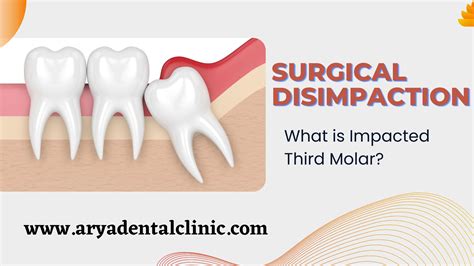 Surgical Disimpaction:- What is Impacted Third Molar? – Arya Dental Clinic