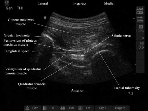 Ischial Bursitis Ultrasound