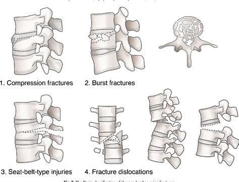 Do thoraco-lumbar spinal injuries classification systems exhibit lower inter- and intra-observer ...