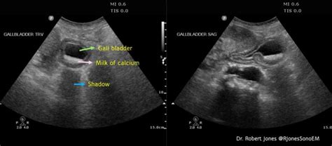 Renal milk of calcium cysts – NephroPOCUS