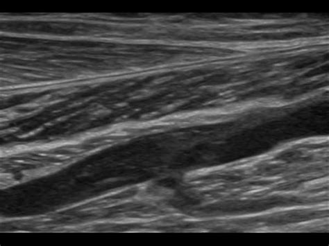 Peripheral vessels | 10.2 Peripheral veins : Case 10.2.3 Recanalized ...