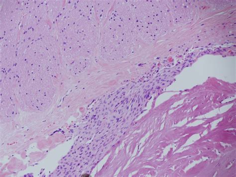 An Unusual Radiological Presentation of Optic Nerve Sheath Meningioma - Dr Timothy Steel ...