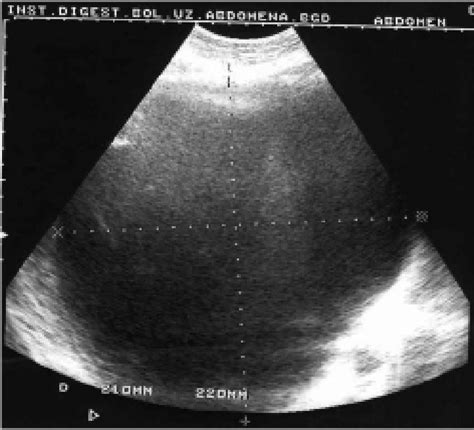 Ultrasound scan of the huge liver cyst. Figure 2. MRI demonstrating the ...