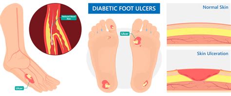 Diabetic Foot Amputation