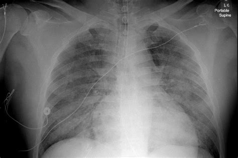 Dr. Smith's ECG Blog: Briefly without pulse, has pulmonary edema and ...