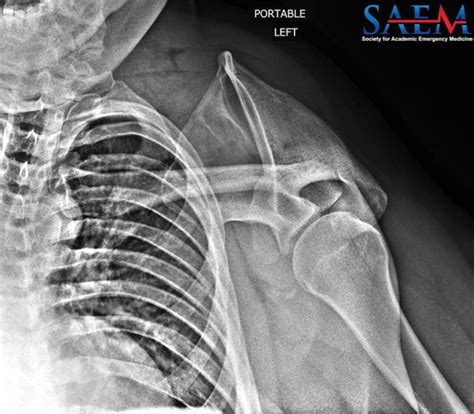 SAEM Clinical Image Series: Left Shoulder Pain