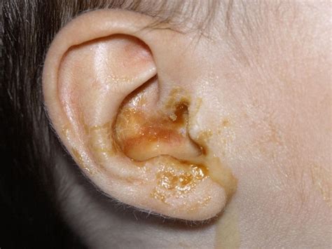 Ear Discharge: Strong Causes And Prevention - HealthPulls