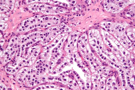 File:Clear cell papillary renal cell carcinoma - very high mag.jpg