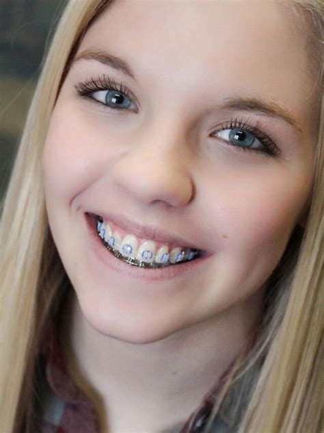 Pin by elpotrillo31 on Braces | Braces girls, Braces colors, Cute braces