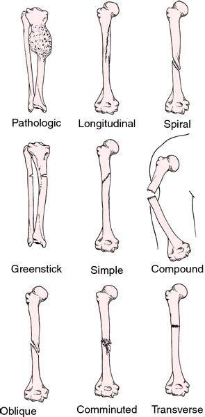 Compound Fracture Diagram