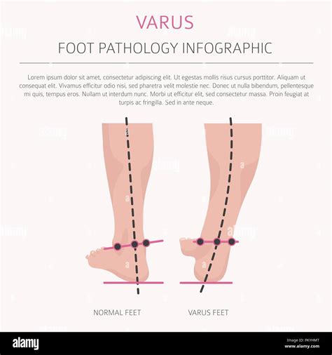 Foot deformation as medical desease infographic. Valgus and varus defect. Vector illustration ...