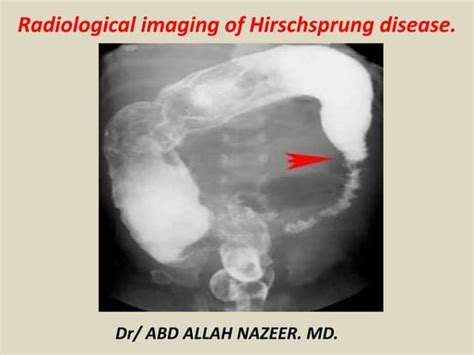 Hirschsprung Disease | PPT