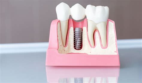 Possible Causes of Dental Implant Failure: Symptoms and Prevention ...