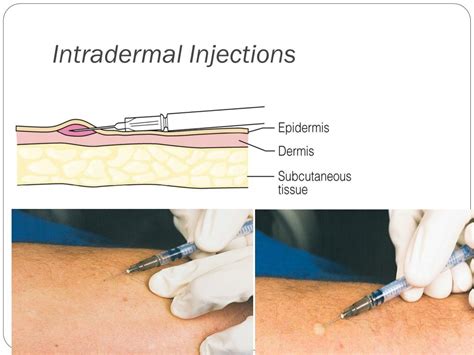 Intradermal Injection