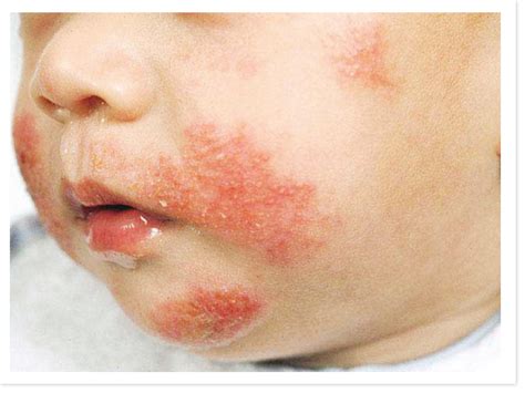 Common baby skin problems - Mother, Baby & Kids