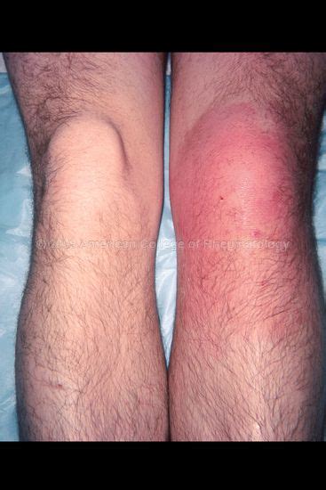 Rheumatology Image Bank : Septic Prepatellar Bursa | Arthritis, Bursitis knee, Bursitis