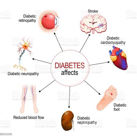 Diabetes Mempengaruhi Komplikasi Diabetes Melitus Ilustrasi Stok - Unduh Gambar Sekarang ...