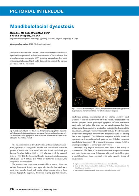 (PDF) Mandibulofacial dysostosis