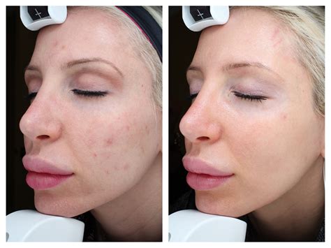 Before and After: my Halo Laser Treatment Results! — Med-E-Spa