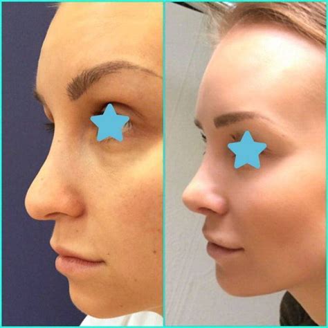 Bulbous Nose Surgery Before And After | Nose surgery, Bulbous nose, Acne treatment