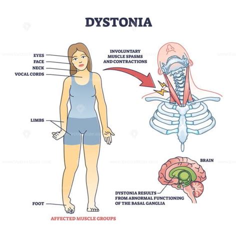 Dystonia disorder as abnormal muscle spasms and contractions outline ...