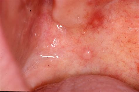 ORAL & MAXILLO-FACIAL SURGERY: Mucocele and Ranula