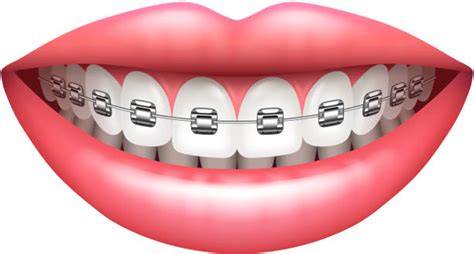 Dental Braces Clipart Free