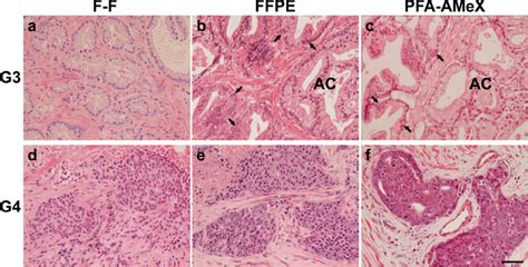 Histological features of prostatic adenocarcinoma Gleason patterns 3 ...