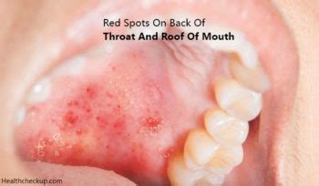 Red Spots on Back of Throat and Roof of Mouth - Causes, Diagnosis ...