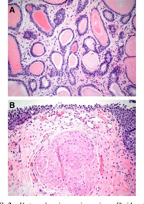 Figure 3 from Diagnosis and Management of a Prolapsing Intravesical Ureterocele in a Man ...