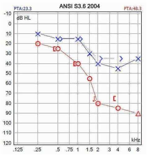 Audiogram Conductive Hearing Loss