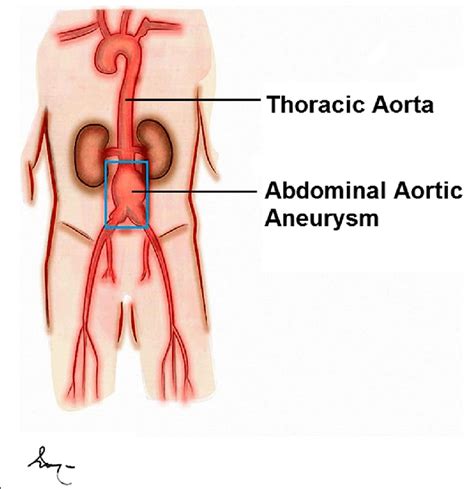 Schematic drawing of the human aorta and the location in the infrarenal... | Download Scientific ...